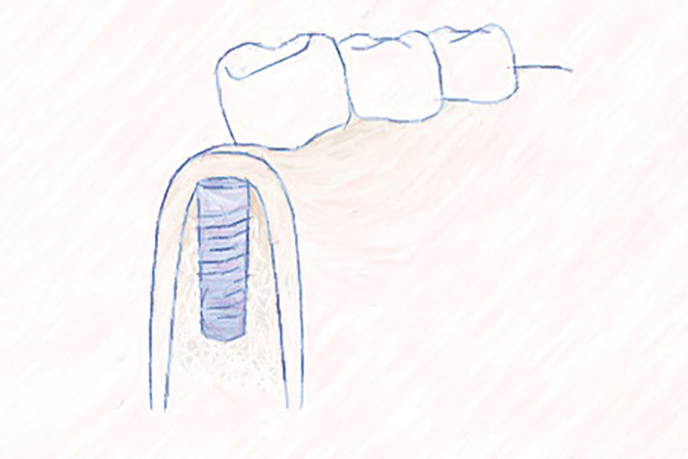Zahnarzt-Nürnberg-Erlenstegen Schiml Fachzahnarzt Oralchirurgie Wo kann ich einen Knochenaufbau durchführen lassen